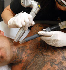 Gang Tattoo Removal