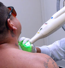 Tattoo Removal